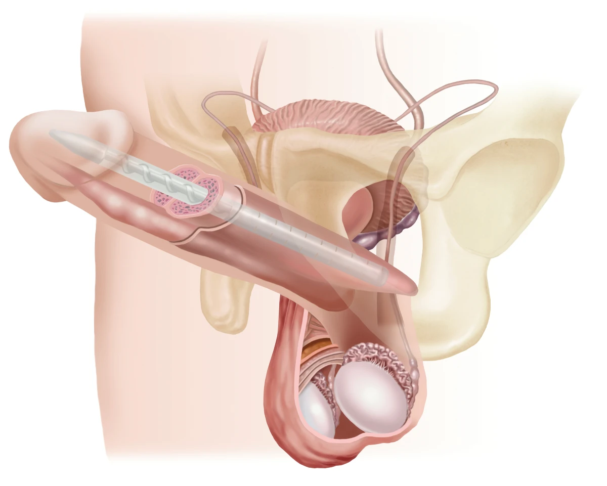 Penisimplantat – Lage des halbstarren Implantats