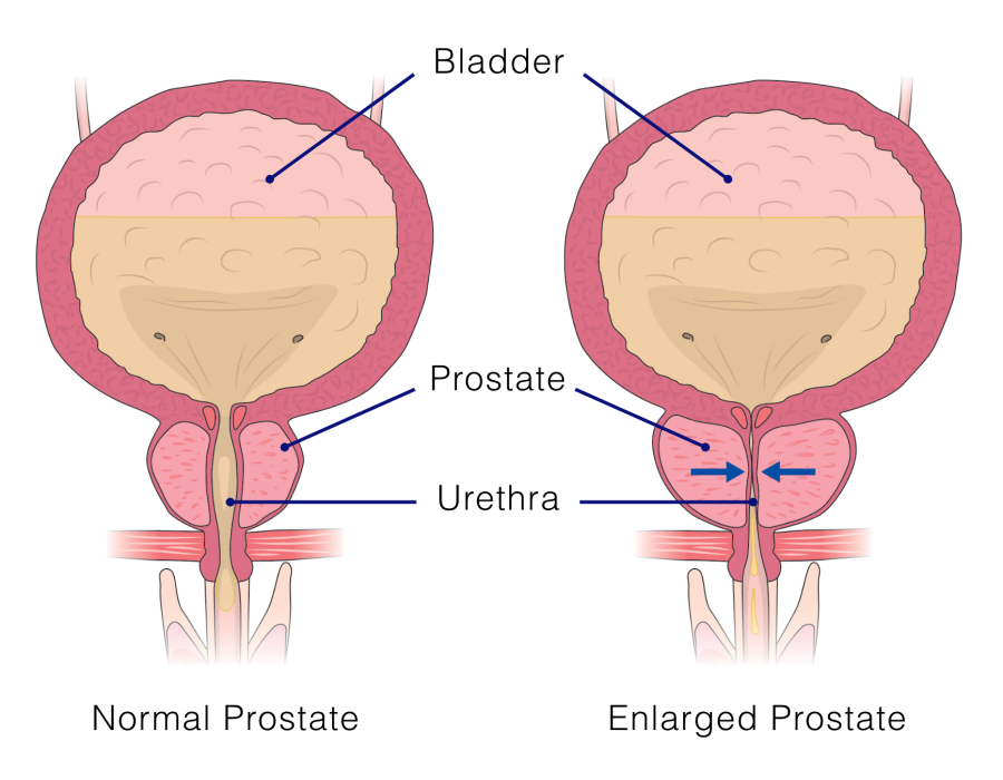 Grafika przedstawiająca przerost prostaty. Własność grafiki: Olympus