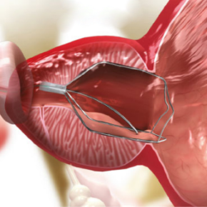 iTind - Okres implantacji